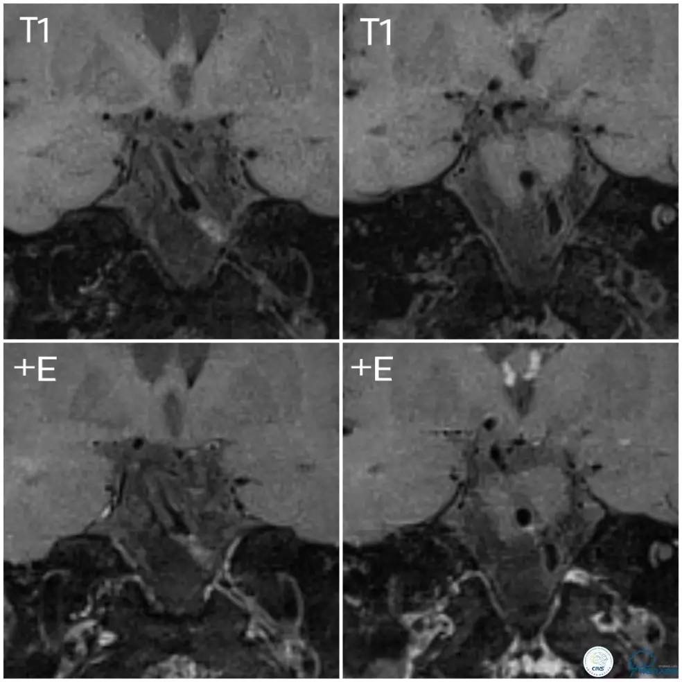 天坛周记｜基底动脉狭窄合并动脉瘤血管内介入治疗一例