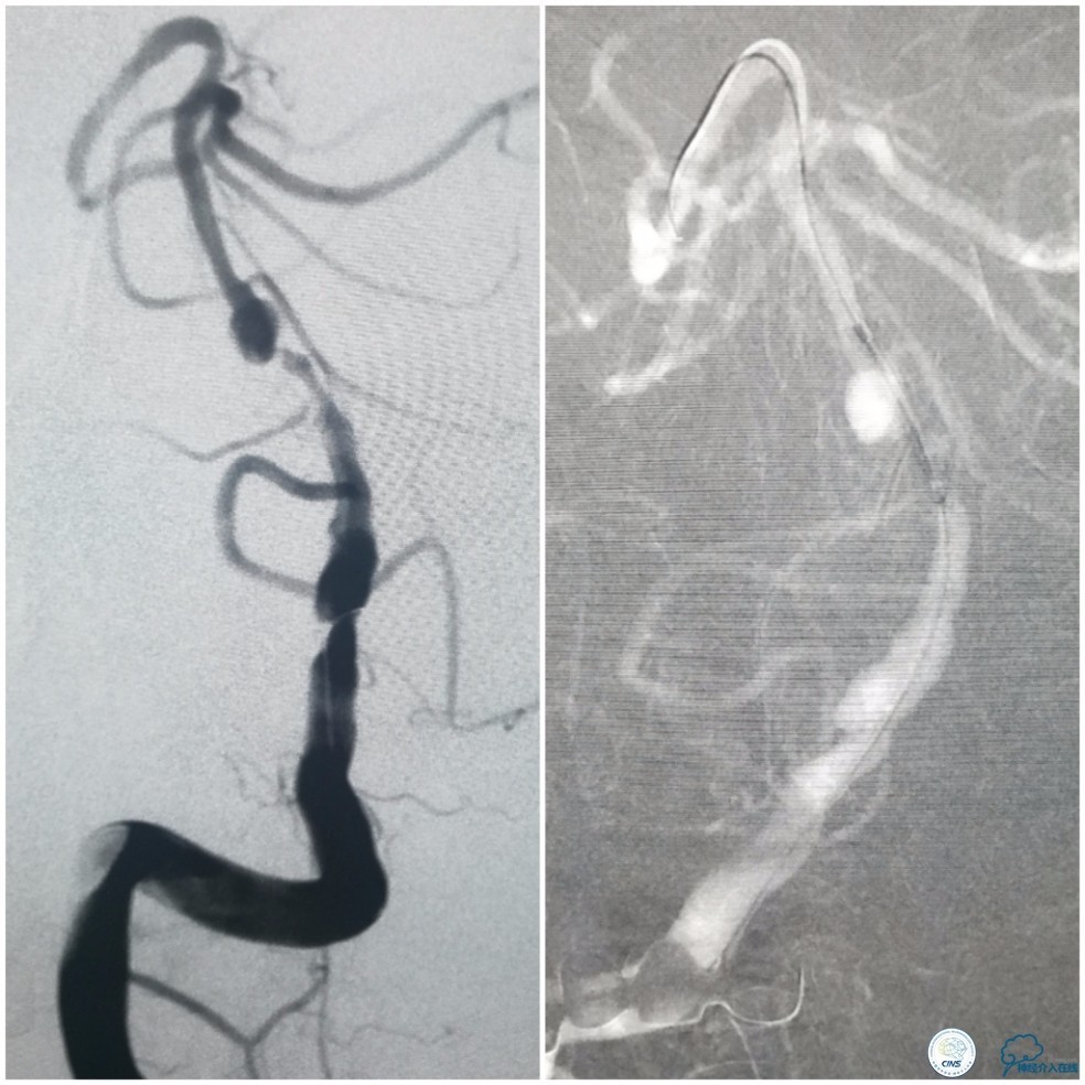 天坛周记｜基底动脉狭窄合并动脉瘤血管内介入治疗一例