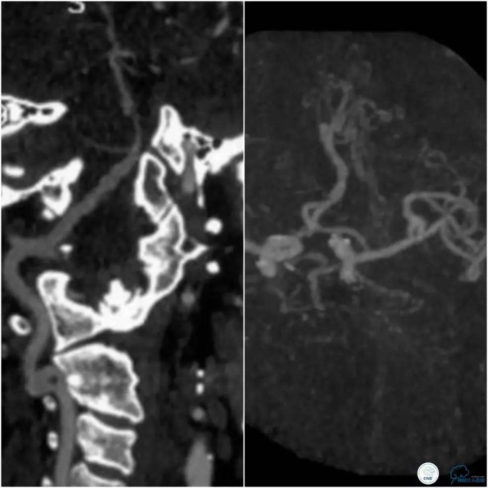 天坛周记｜基底动脉狭窄合并动脉瘤血管内介入治疗一例