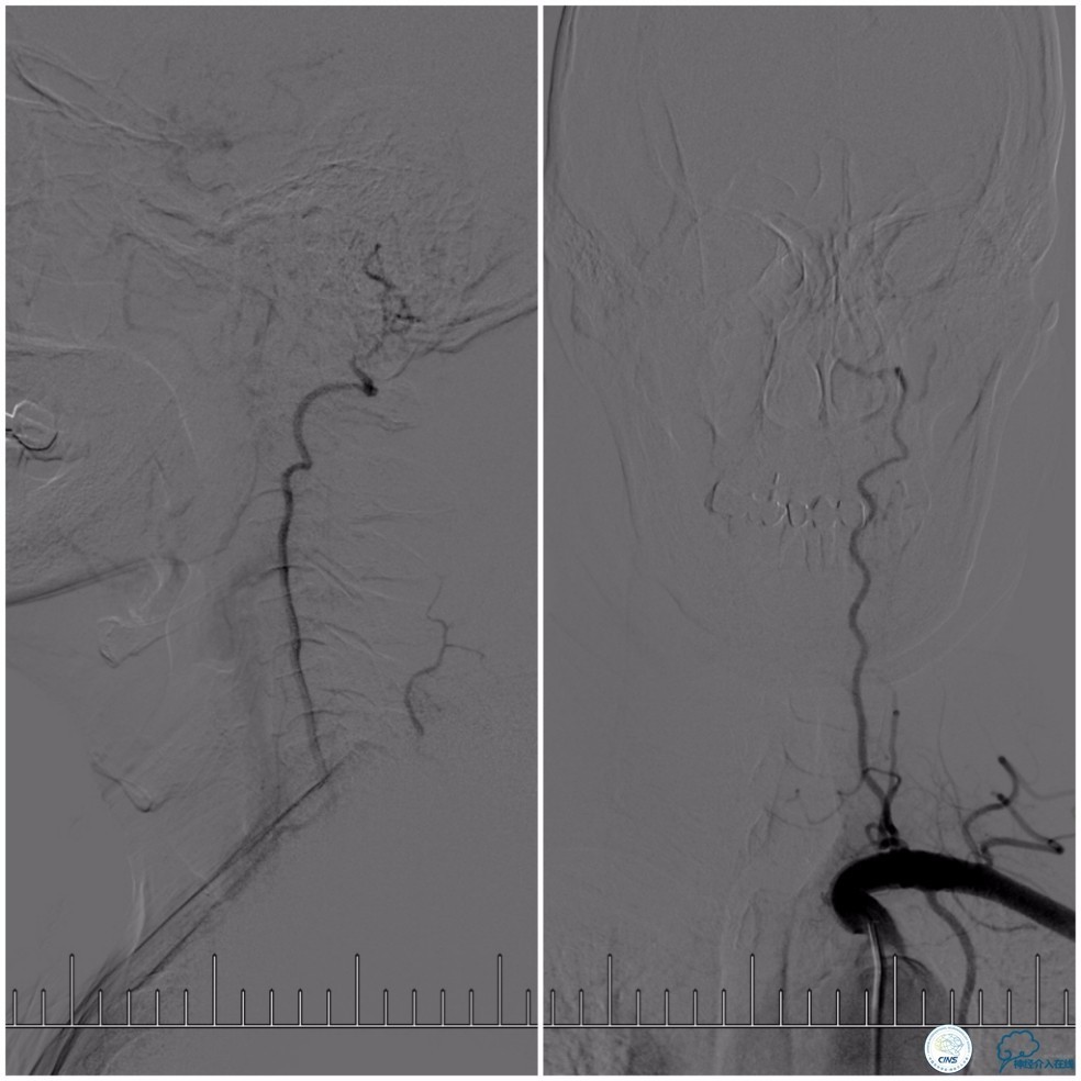 天坛周记｜基底动脉狭窄合并动脉瘤血管内介入治疗一例