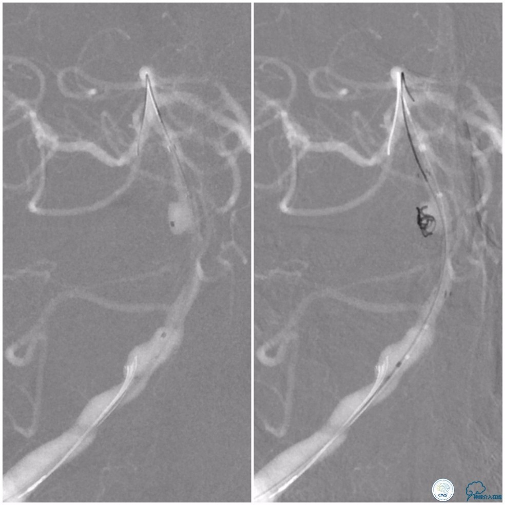 天坛周记｜基底动脉狭窄合并动脉瘤血管内介入治疗一例