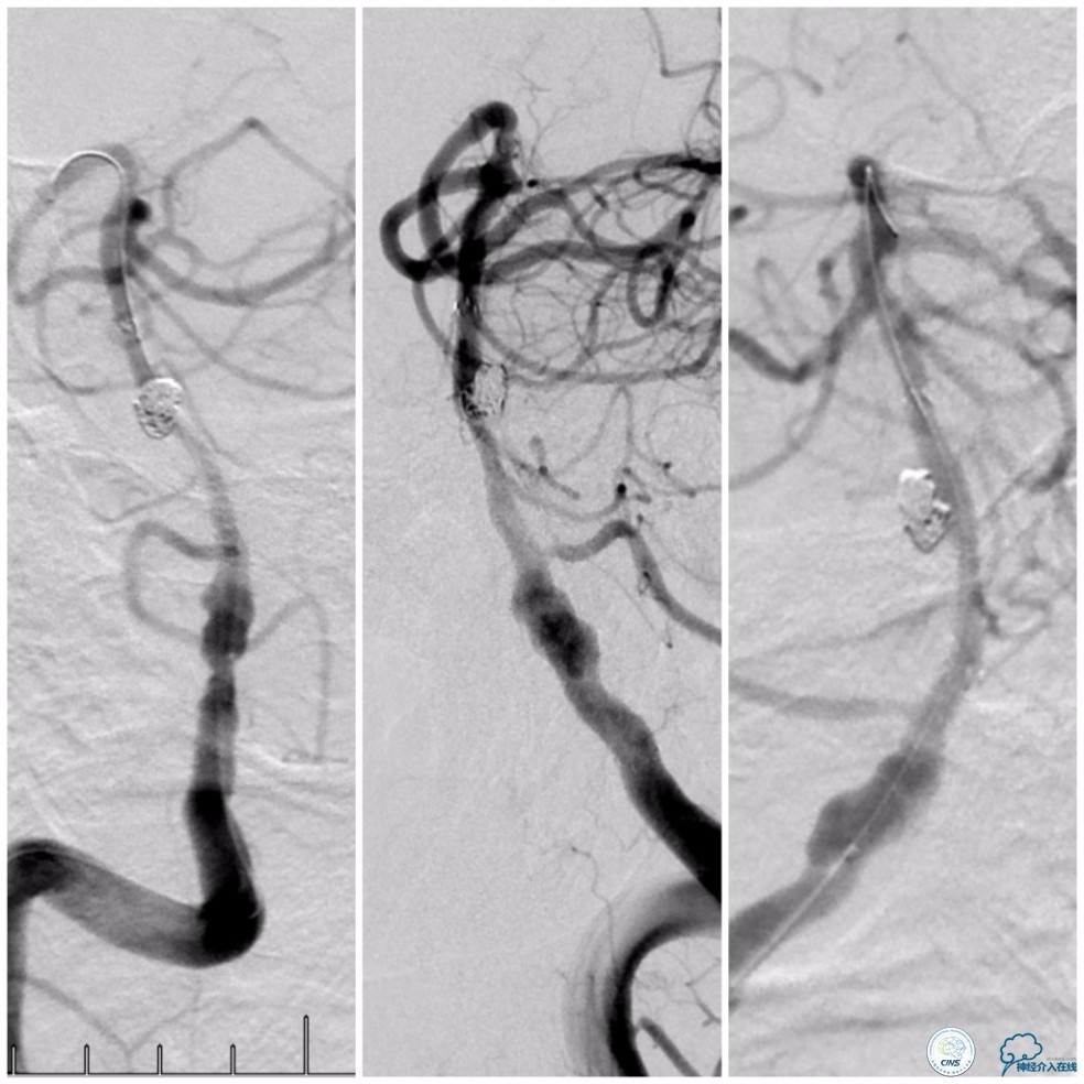 天坛周记｜基底动脉狭窄合并动脉瘤血管内介入治疗一例