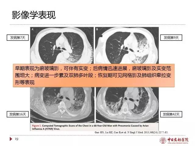 「规范与指南」人感染H7N9禽流感诊疗方案（2017年第一版）