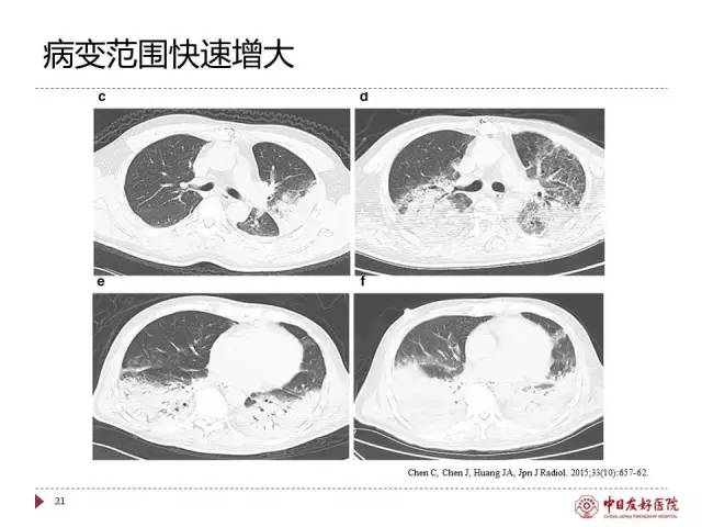 「规范与指南」人感染H7N9禽流感诊疗方案（2017年第一版）