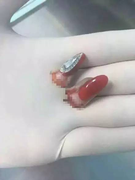老师给幼儿剪指甲不小心剪到手,幼儿园小孩被老师剪指甲流血