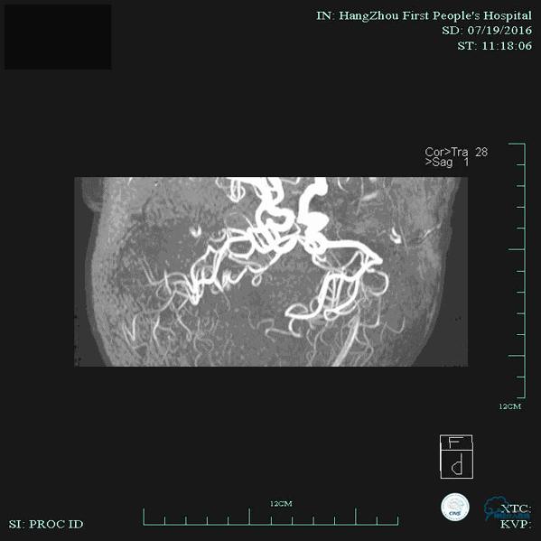 CINS2016病例展｜一例双侧大脑前动脉栓塞的再通治疗