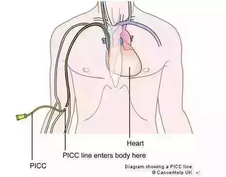 picc堵管是什么原因引起的,picc管为什么会堵
