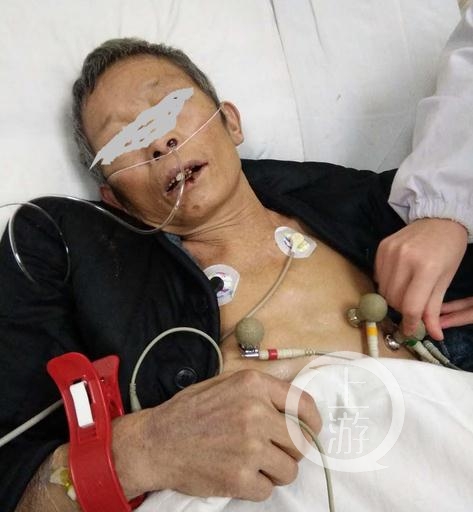 湖南一老人拘押期间身亡,曾在看守所内断了14根肋骨