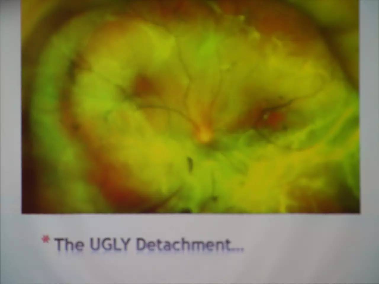 pvr眼科上是什么意思,pvr在眼底是什么病