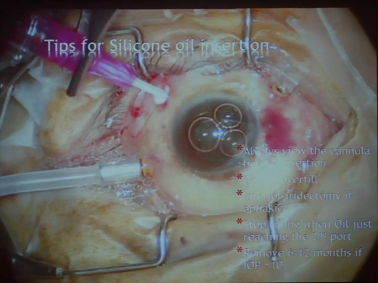 pvr眼科上是什么意思,pvr在眼底是什么病