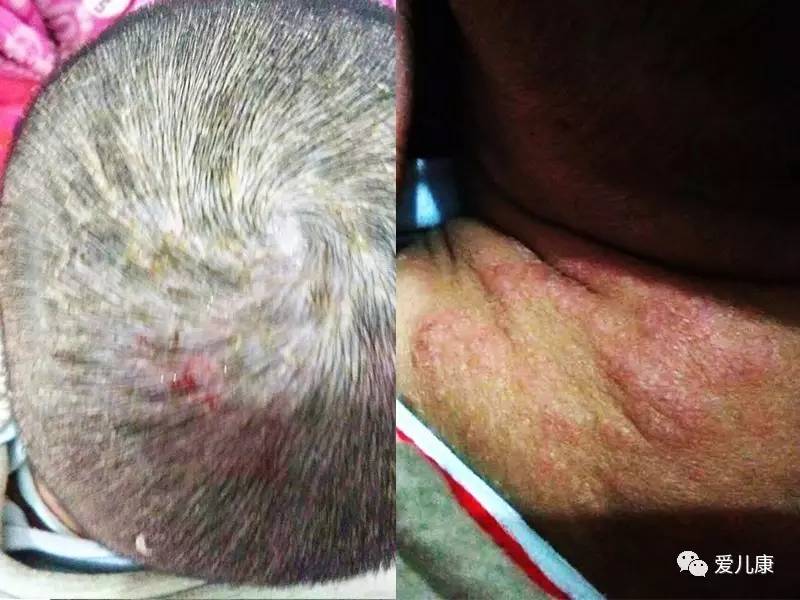 宝宝脂溢性皮炎怎么治疗效果最好,脂溢性皮炎宝宝要注意哪些方面