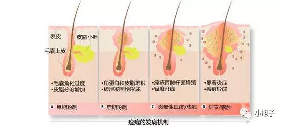 想治好痘痘、痘印、闭口你必须先知道这个!