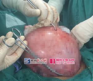 「惊呆」柳州一大妈肚子大得像怀孕7个月,医生打开后惊呆了……