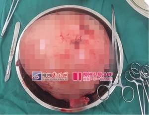 「惊呆」柳州一大妈肚子大得像怀孕7个月,医生打开后惊呆了……