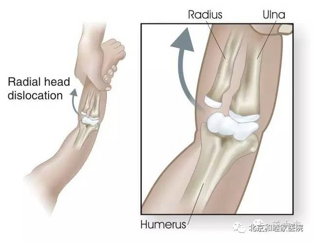 牵拉肘关节脱位,肘关节半脱位为什么要牵拉