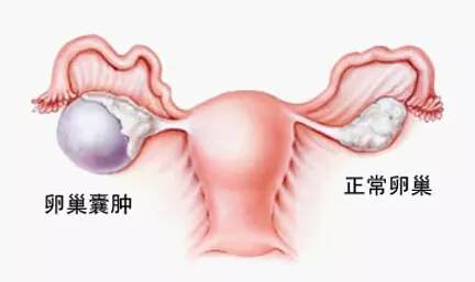 「惊呆」柳州一大妈肚子大得像怀孕7个月,医生打开后惊呆了……