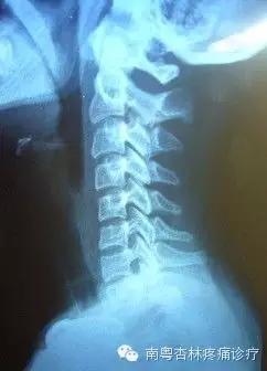 颈椎曲度变直是什么意思严重吗,颈椎生理曲度变直什么原因引起的