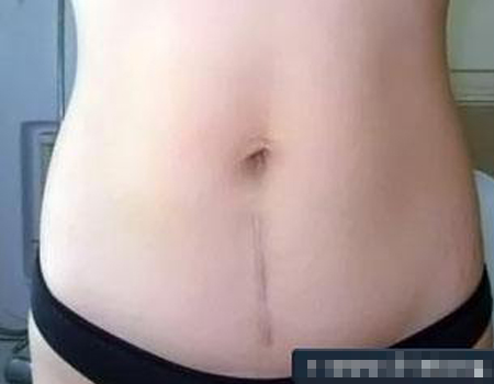 女人剖腹产之后腰疼,女人剖腹产之后的文案