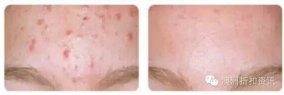 benzac祛痘膏使用方法,benzac祛痘膏测评