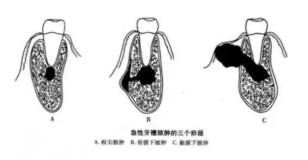 牙痛的用药技巧你知道多少,儿童牙痛用药