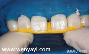 门牙有缝的女人有什么不好,门牙有缝怎么办