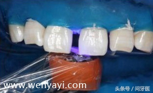 门牙有缝的女人有什么不好,门牙有缝怎么办