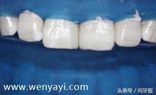 门牙有缝的女人有什么不好,门牙有缝怎么办