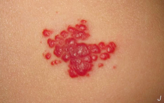 婴幼儿血管瘤会自己消除吗,血管瘤属于恶性肿瘤还是良性肿瘤