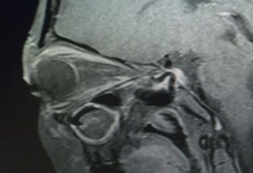 mri和核磁共振检查有什么区别,mri检查和核磁共振有区别吗
