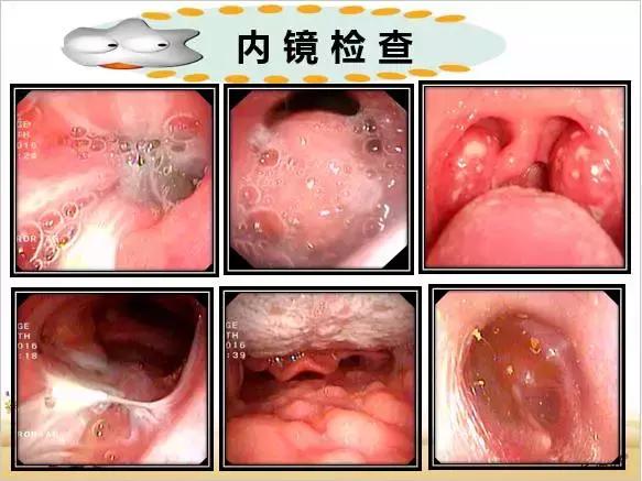 咳嗽咳痰反复发烧,宝宝反复咳嗽咳痰