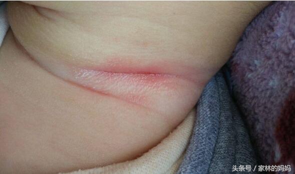 宝宝脖子淹了用什么方法解决,宝宝淹脖子妈妈忌口