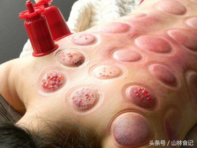 赤小豆祛湿神器,祛湿薏米赤小豆茯苓茶有用吗