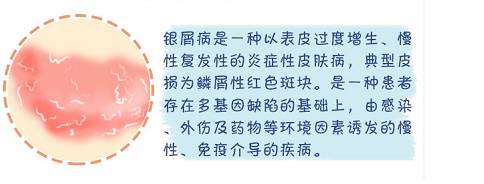 周主任讲解银屑病,银屑病健康宣教计划