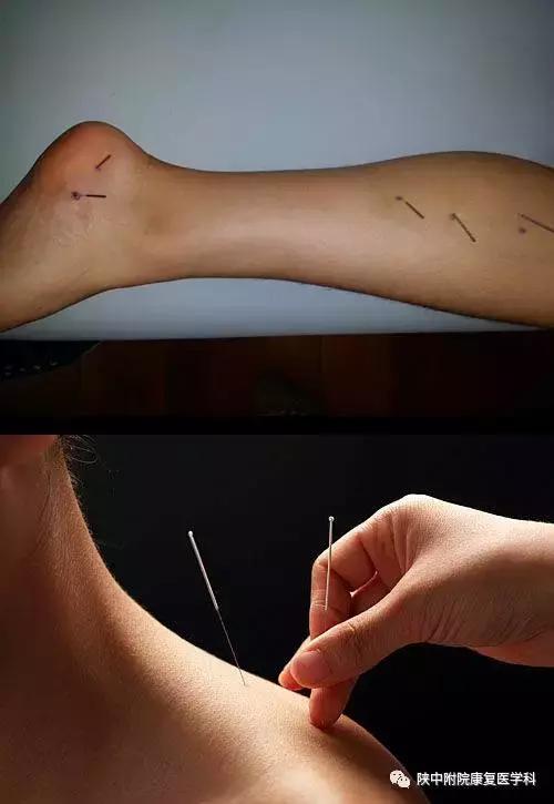 扎针治疗疼痛的原理,治疗疼痛最好的针法