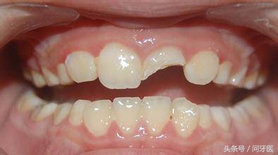过年牙齿掉了一块,过年牙齿掉好不好