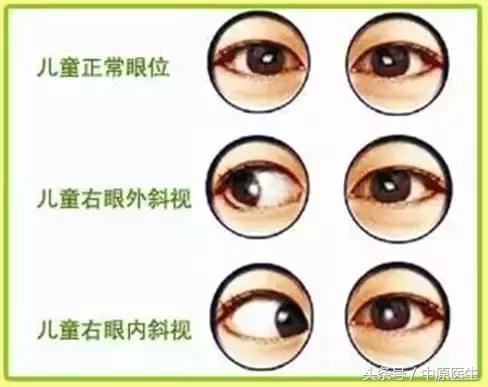 发现自己好像得了斜视怎么办,有轻微的斜视怎么办