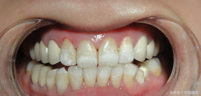 怎样保护牙龈不萎缩,牙龈萎缩恢复小妙招