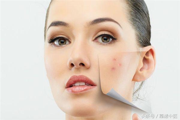 冒痘之后有很多痘印怎么消除,疮疤去除