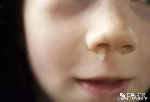 鼻窦炎引起头痛怎么治疗,鼻窦炎的症状及食疗视频播放