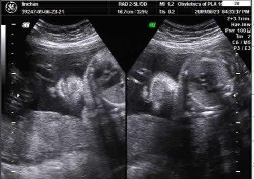 产检4维有必要做四五次吗,产检要做几次4d彩超