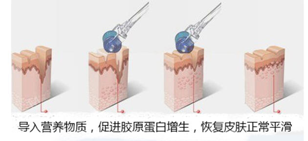 黄金微针祛除颈纹,去除颈纹的微针视频