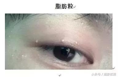 怎么区分汗管瘤脂肪粒还是粟丘疹,眼周的脂肪粒不去除