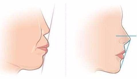 如何判断牙齿是否深度覆合,怎样矫正牙齿深覆合