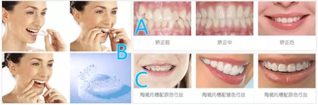 莫错过孩子牙齿最佳矫正年龄,4-5岁儿童矫正牙齿最佳年龄