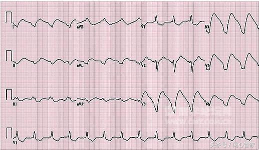 室性期前收缩治疗药物,仅用于室性心律失常有效的药物是