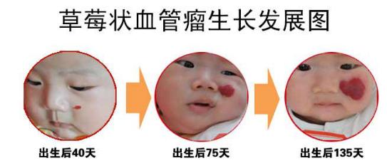 为什么胎记除不了根,为什么胎记不能被别人看见