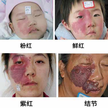 为什么胎记除不了根,为什么胎记不能被别人看见