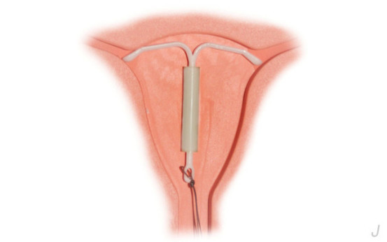 节育环不取后果很严重，错过取环的最佳时间只会更遭罪