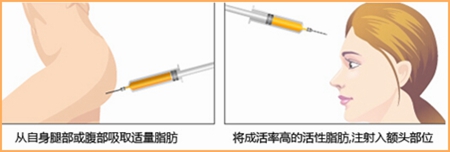 自体脂肪丰额头的案例,自体脂肪丰额头效果如何