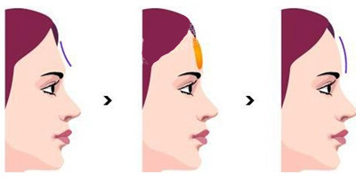 自体脂肪丰额头的案例,自体脂肪丰额头效果如何